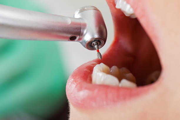 Best Emergency Dentist for Lost Fillings or Crowns in Georgetown, PA